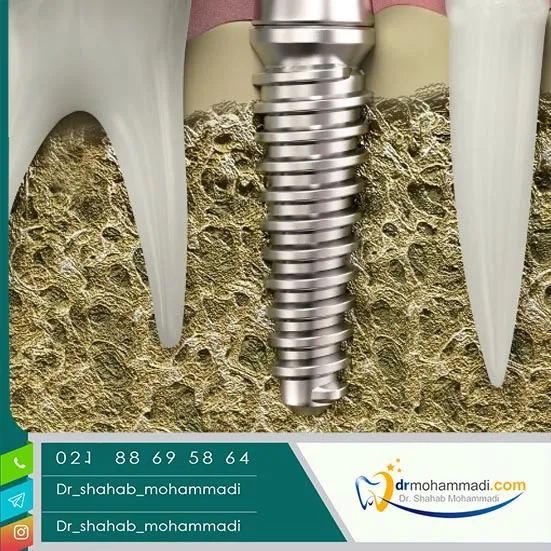 جوش خوردن به استخوان